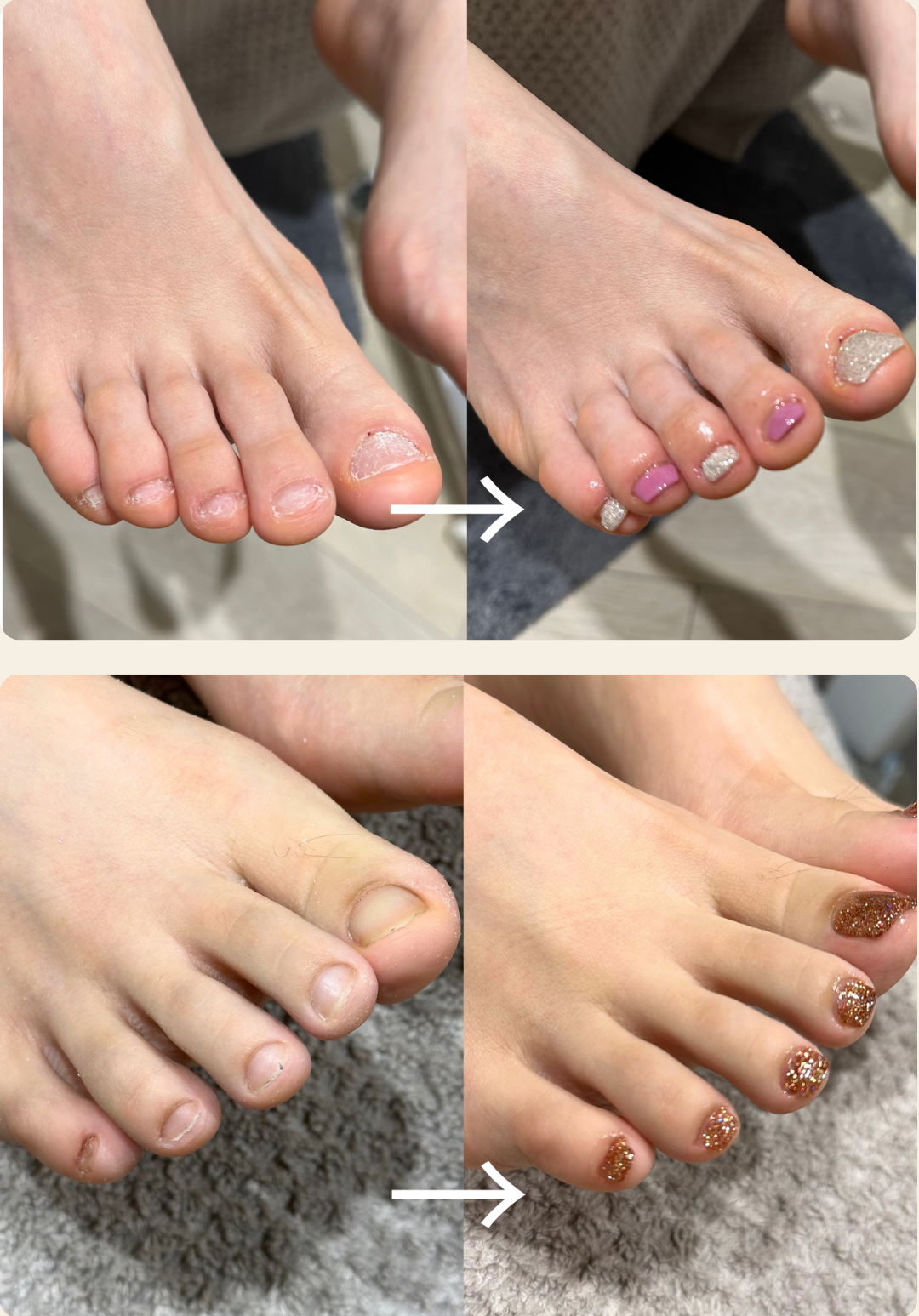 リプロネイル式深爪矯正の事例